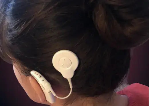 Implant cochléaire porté par une jeune femme
